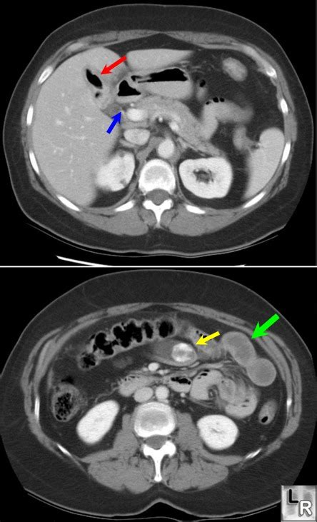 Learning Radiology - Gallstone Ileus