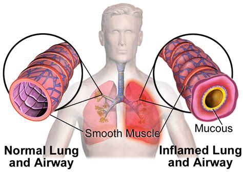 What Is Asthma?