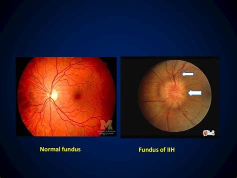 Idiopathic intracranial hypertension