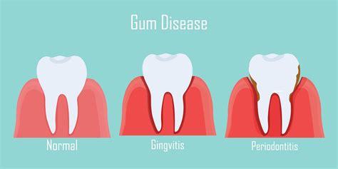 What are the Symptoms of Gingivitis? - Worlds Family Medicine