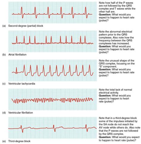 Solved Look at the ECG Abnormalities graphs in Figure 19.25 | Chegg.com