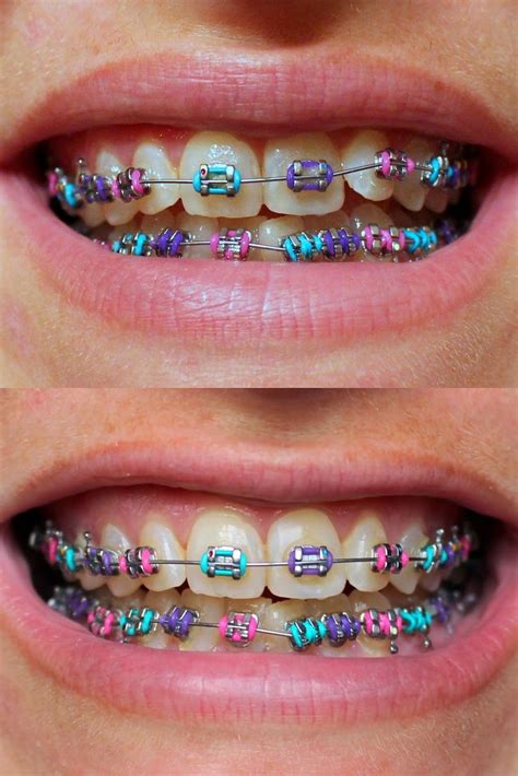 Purple - Pink - Blue | Cute braces, Braces tips, Teeth braces