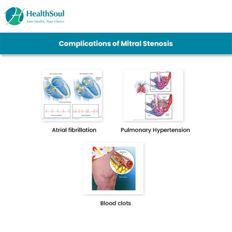 Mitral Valve Stenosis: Symptoms and Treatment | Cardiology | HealthSoul