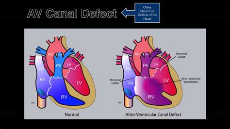 Fetal Echocardiography: AV Canal Defect - YouTube