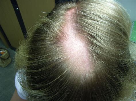 Medical Pictures Info – Alopecia Areata