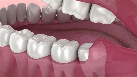 Tips For Recovering From Wisdom Tooth Extraction Center For Implant ...