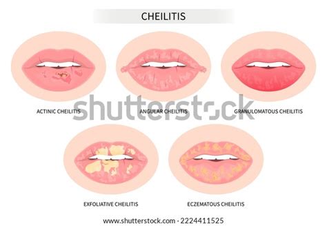 Types Dry Lip Fungal Oral Cold Stock Vector (Royalty Free) 2224411525 | Shutterstock