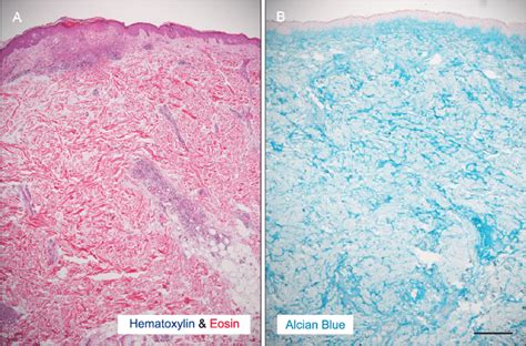 Histological findings. (A) Focal epidermal atrophy and hydropic... | Download Scientific Diagram