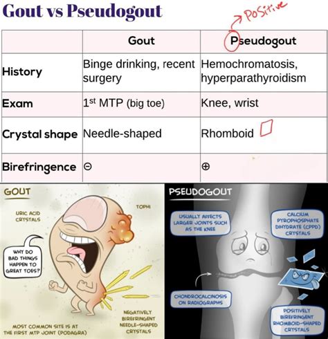 Gout Vs Pseudogout Crystals