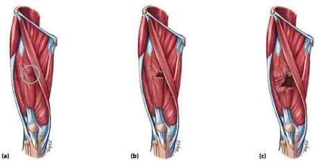 Hamstring Tear Grades