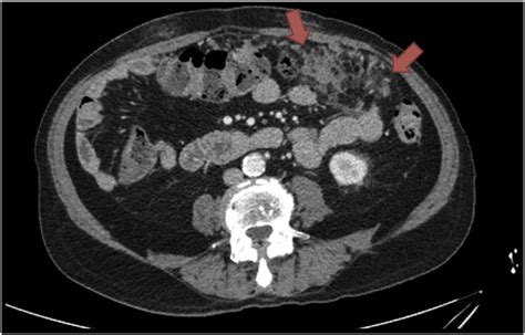 Omental Caking Symptoms, Causes, Radiology, Prognosis, Treatment