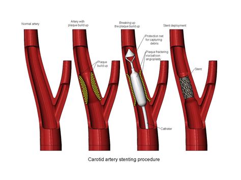 Carotid Artery Stenting Procedure Diorama - 3D Model by RachidSW