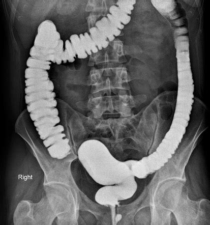 Dolichocolon | Radiology Reference Article | Radiopaedia.org