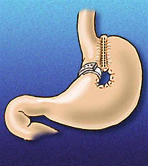 Bariatric metabolic surgery | proLékaře.cz