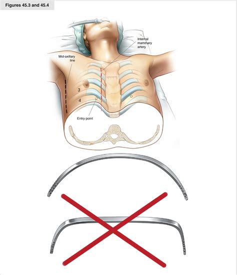 Pectus Excavatum Bar