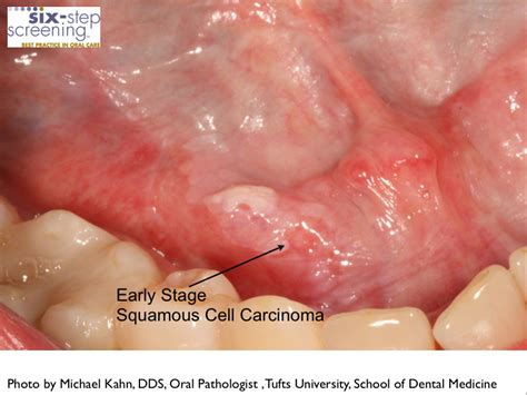 Is It Oral Cancer? | Six-Step Screening