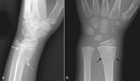 Greenstick Fracture X Ray