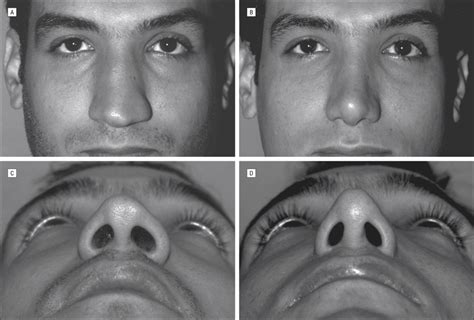 Preoperative photographs (A and C) of a patient with a wide nasal base... | Download Scientific ...