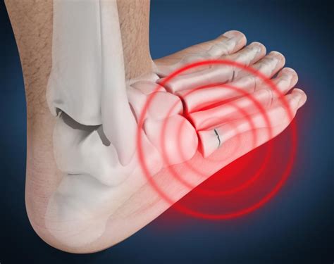 1St Metatarsal Pain Top Of Foot : Radiographic Views And Associated Joint Angles Top Lateral ...