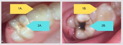 Silver diamine fluoride – Public Health