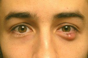 What is an eye cyst? Types of conjunctival cystic diseases.