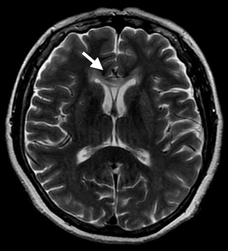 Brain Scans For Substance Abuse