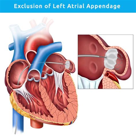 Exclusion of Left Atrial Appendage | Professor Kevin P Walsh