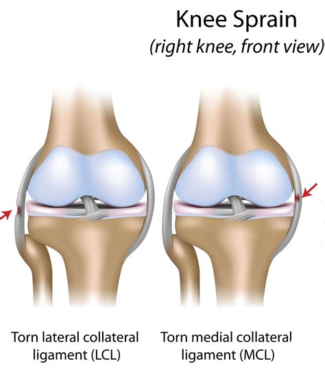 Knee Sprain Treatment - Rehab Exercises to Heal Fast and Strong - Physio Prescription