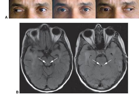 Bilateral internuclear ophthalmoplegia - American Academy of Ophthalmology