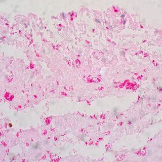 Pseudomembranous Tracheitis, Kinyoun Carbolfuchsin Acid-Fa… | Flickr