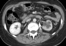 Medical Treatment Pictures-for Better Understanding: Retroperitoneal Fibrosis