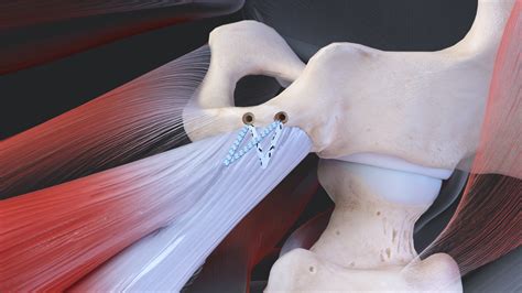 Arthrex - Proximal Hamstring Tendon Repair