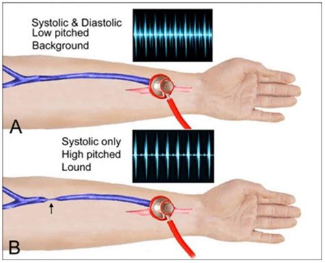 What Is A Dialysis Fistula Bruit? Azura Vascular Care, 41% OFF