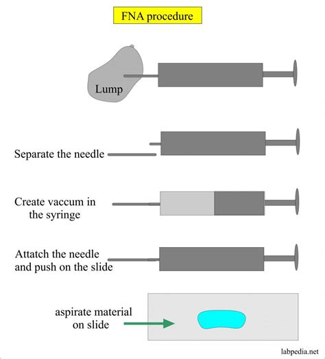 Needle Aspiration Procedure