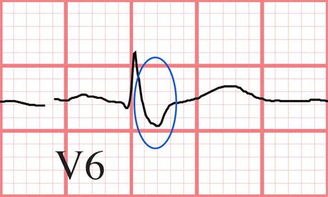 RBBB ECG