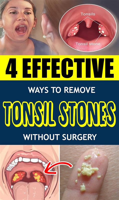 4 EFFECTIVE WAYS TO REMOVE TONSIL STONES WITHOUT SURGERY