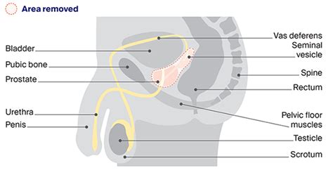 Male orgasm after prostate removal – Telegraph