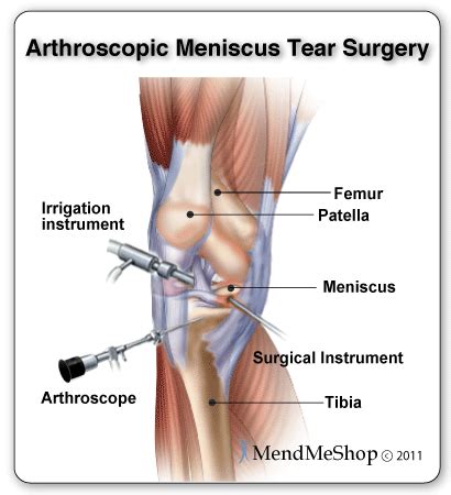 Torn Meniscus Surgical Treatments