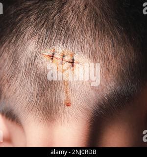 The lacerated suture wound of head which suture by nylion suture about 3 stitches Stock Photo ...