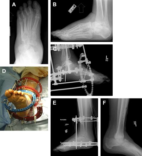 Surgical Reconstruction of the Charcot Rearfoot and Ankle - Clinics in Podiatric Medicine and ...