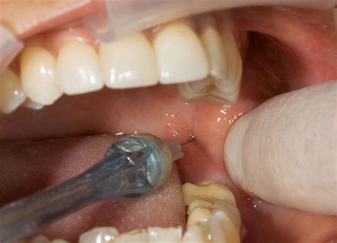 Local Anesthesia - Local Anesthesia Drugs - Local Anesthesia in Dentistry