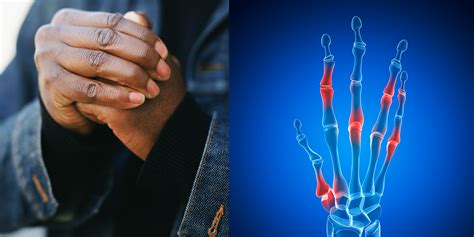 Does Cracking Your Knuckles Cause Arthritis? | SELF