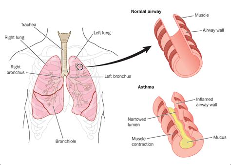 Asthma Lungs Compared To Normal Lungs