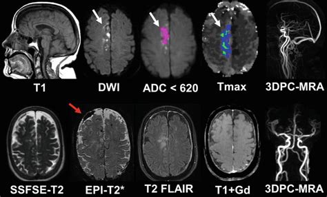 Stroke Brain Mri