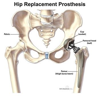 Stryker Hip Recall 2016 - NJ Hip Replacement Lawsuit Attorney