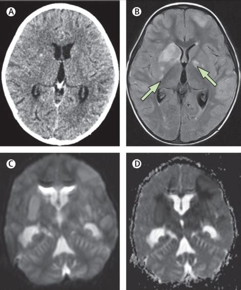 References in Tuberculous meningitis: more questions, still too few answers - The Lancet Neurology