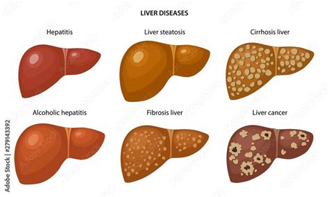 Vecteur Stock Liver disease: fatty, fibrosis, alcoholic hepatitis ...