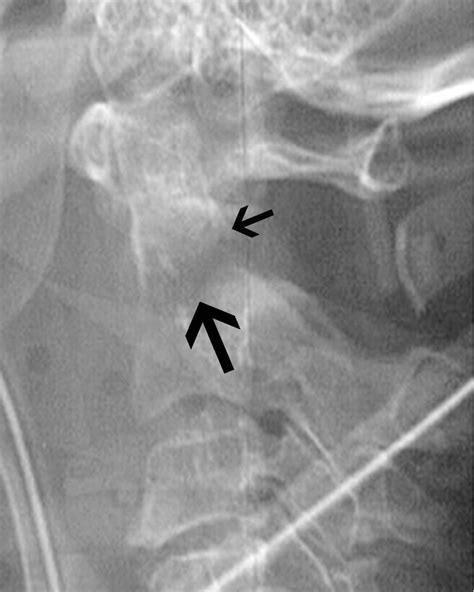 Spectrum of Imaging Findings in Hyperextension Injuries of the Neck | RadioGraphics