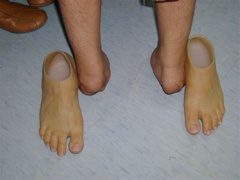 Synergy Functional Prosthetic Silicone Partial Foot Prosthesis, Below the Knee, Right & Lift ...