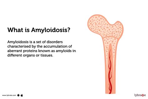 Amyloidosis: Causes, Symptoms, Treatment and Cost